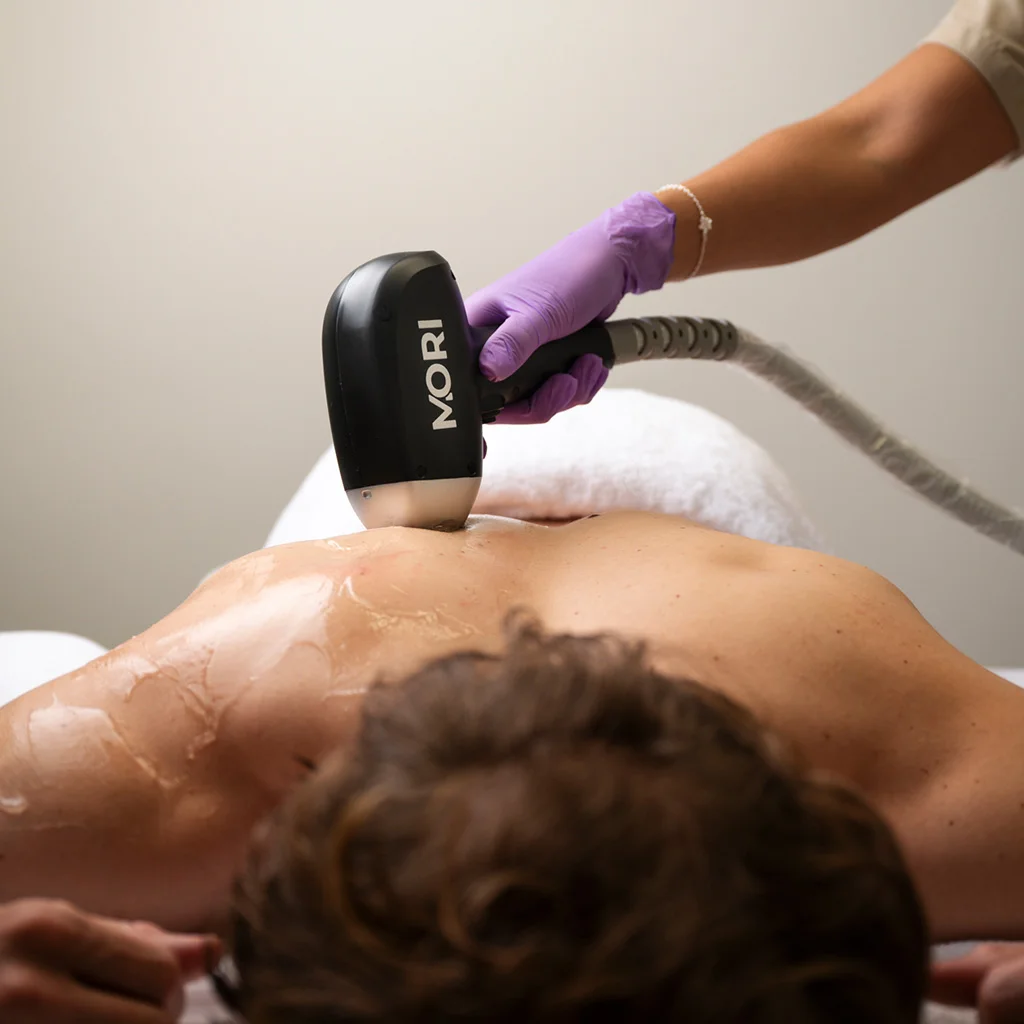 5x Bovenlichaam laserontharen (man)